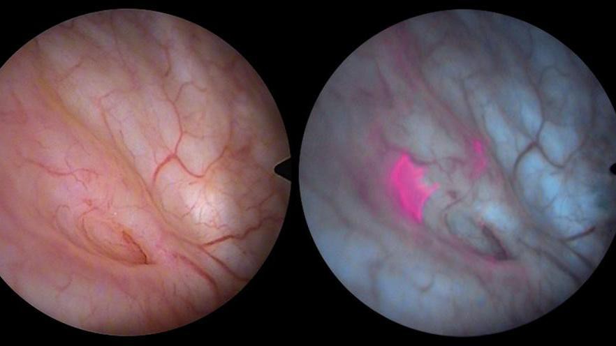 On the left, an invisible bladder tumor. On the right, blue light reveals its presence. On the left, an invisible bladder tumor. On the right, blue light reveals its presence.