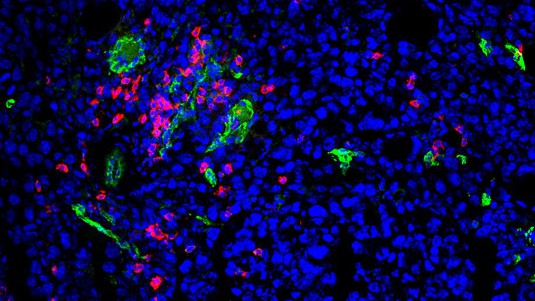 CD8 T cells (red) infiltrate a melanoma. Credit: M. De Palma (EPFL)